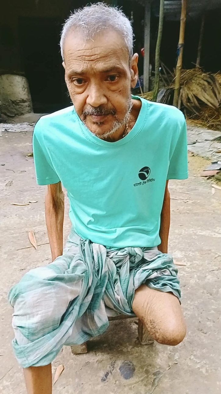 এক পা হারিয়ে থমকে গেছে নন্দীগ্রামের  কুমার অজিত পালের জীবন, ভাঙা ঘরে অনাহারে কাটছে পরিবার